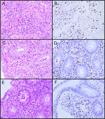 Not enough by half: NFAT5 haploinsufficiency in two patients with Epstein-Barr virus susceptibility